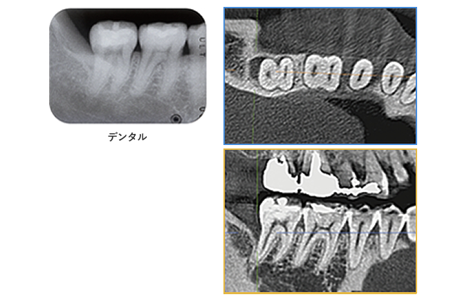歯科用CT｜インプラント治療なら高松市の吉本歯科医院